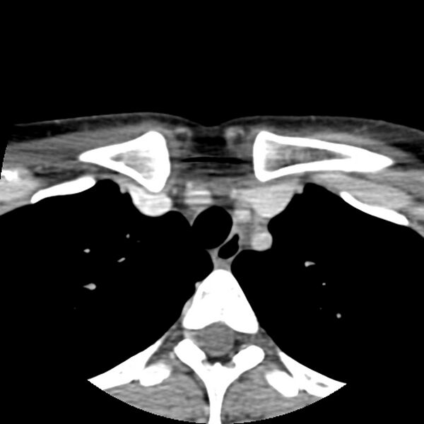 File:Normal CT of the neck (Radiopaedia 14575-14500 Axial C+ 70).jpg