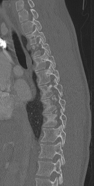 File:Normal CT thoracic spine (Radiopaedia 40181-42688 Sagittal bone window 42).png
