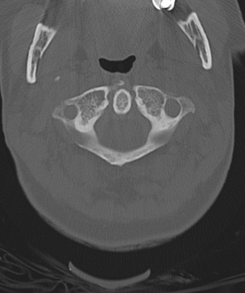 File:Normal cervical spine MRI (including Dixon) (Radiopaedia 42762-45926 Axial bone window 12).png
