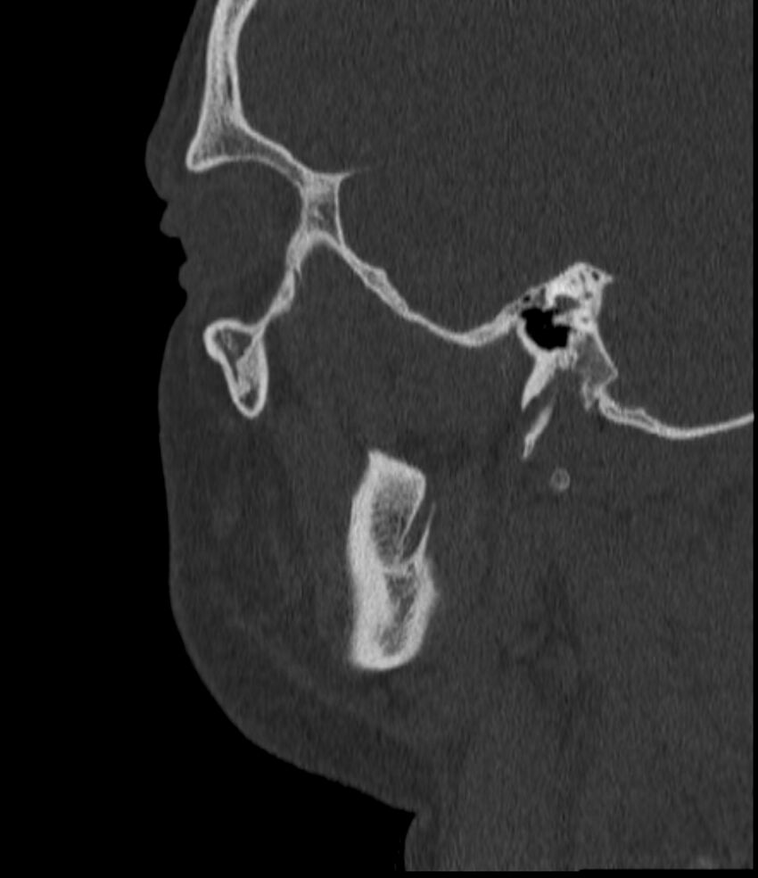 Normal facial bone CT (Radiopaedia 88742-105476 Sagittal bone window 127).jpg