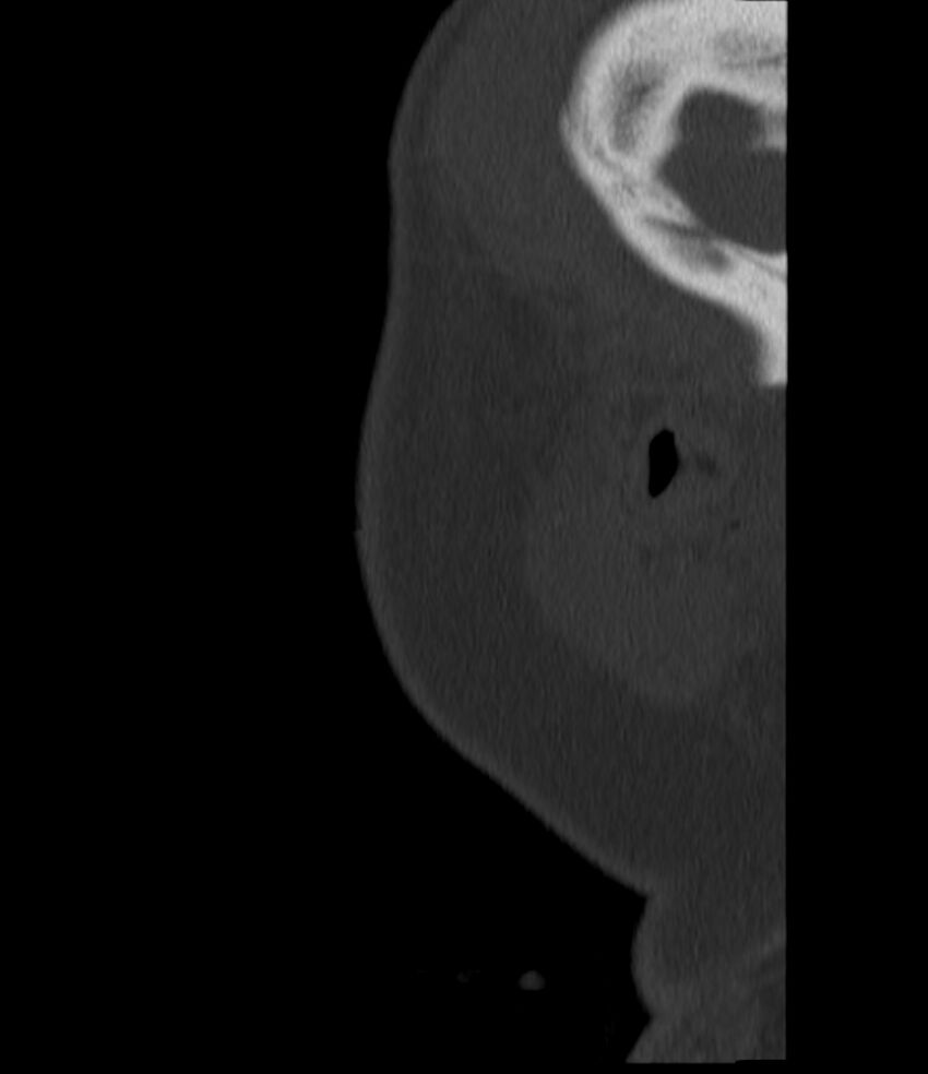 Normal facial bone CT (Radiopaedia 88742-105476 Sagittal bone window 156).jpg