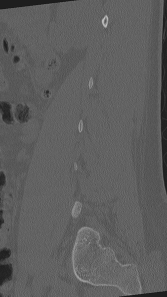 File:Normal lumbar spine CT (Radiopaedia 46533-50986 Sagittal bone window 77).png