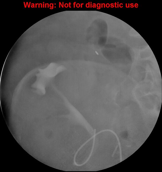 File:Normal retrograde pyelography of a native and transplant kidney (Radiopaedia 40480-43054 Transplant kidney 5).jpg