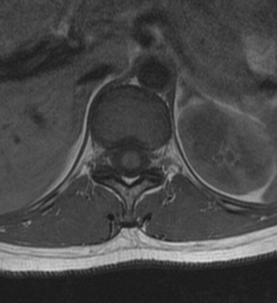 File:Normal thoracic spine MRI (Radiopaedia 41033-43781 Axial T1 25).jpg