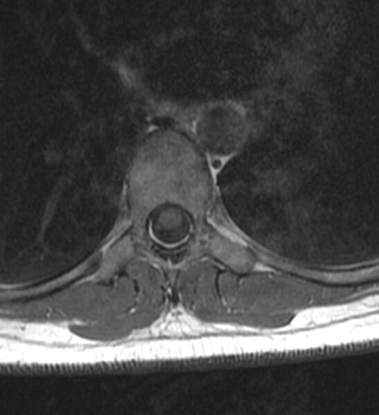 File:Normal thoracic spine MRI (Radiopaedia 41033-43781 Axial T1 4).jpg