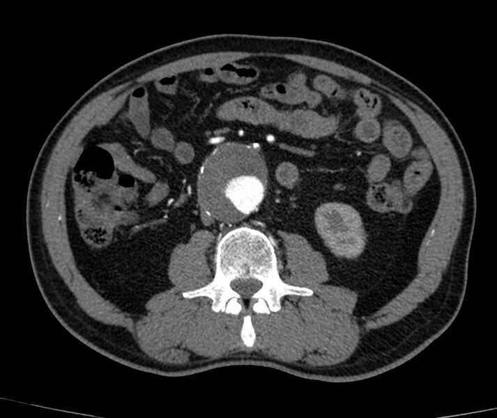 File:Abdominal aortic aneurysm (Radiopaedia 22421-22458 C+ arterial phase 45).jpg