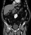 Abdominal aortic aneurysm (Radiopaedia 25855-26001 Coronal C+ arterial phase 22).jpg