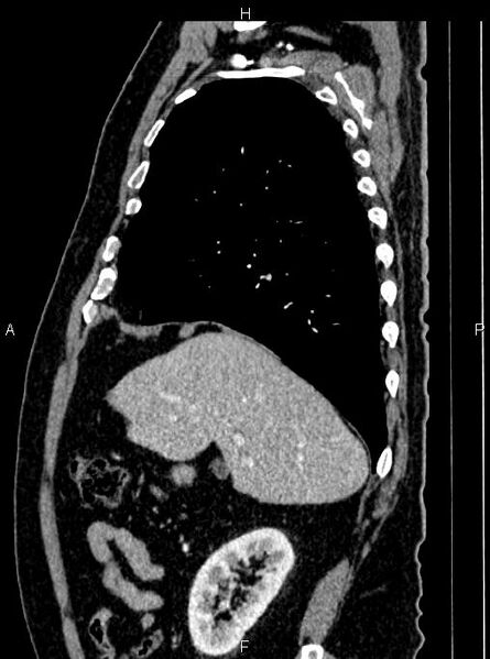 File:Abdominal aortic aneurysm (Radiopaedia 83094-97462 Sagittal renal cortical phase 38).jpg