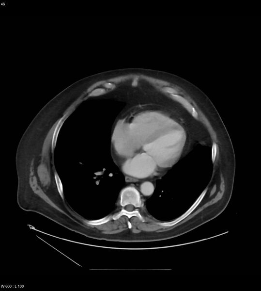File:Abdominal aortic aneurysm with intramural hematoma then rupture (Radiopaedia 50278-55631 Axial C+ arterial phase 37).jpg