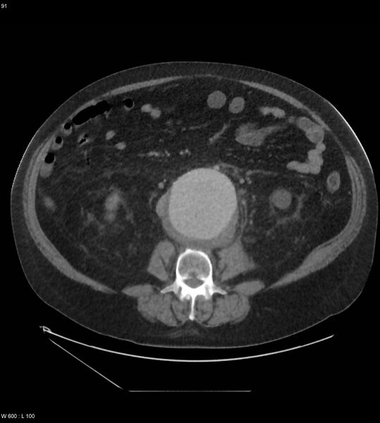 File:Abdominal aortic aneurysm with intramural hematoma then rupture (Radiopaedia 50278-55631 Axial C+ arterial phase 82).jpg