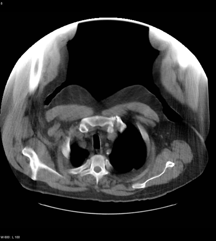 Abdominal aortic aneurysm with intramural hematoma then rupture (Radiopaedia 50278-55631 Axial non-contrast 4).jpg