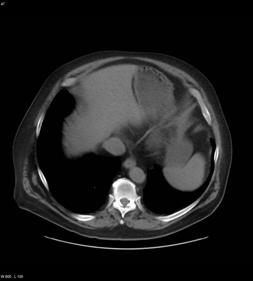 Abdominal aortic aneurysm with intramural hematoma then rupture (Radiopaedia 50278-55631 Axial non-contrast 43).jpg