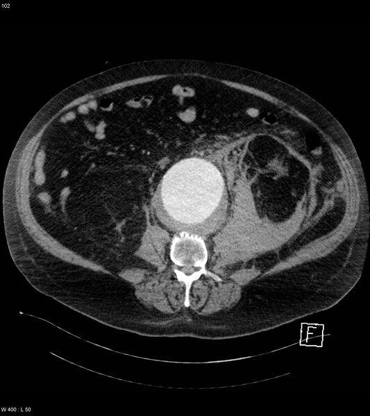 File:Abdominal aortic aneurysm with intramural hematoma then rupture (Radiopaedia 50278-55632 Axial C+ arterial phase 101).jpg