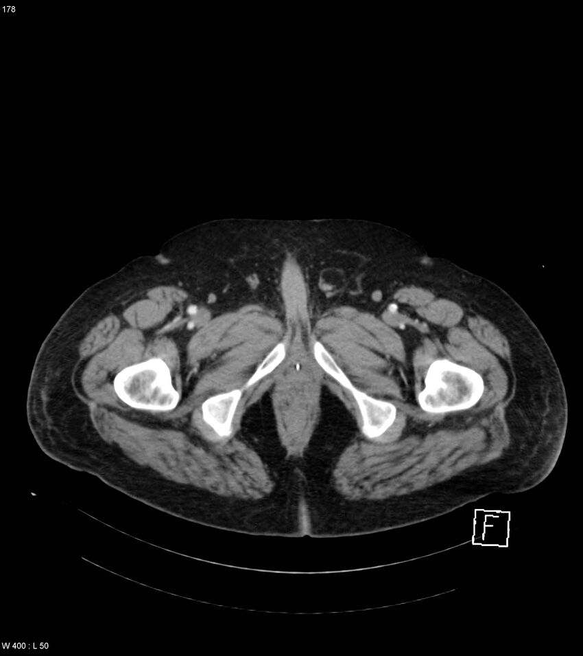 Abdominal aortic aneurysm with intramural hematoma then rupture (Radiopaedia 50278-55632 Axial C+ arterial phase 177).jpg