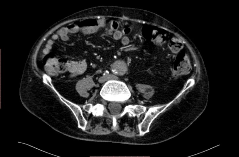 File:Abdominal aortic interposition tube graft and aneurysm thrombosis (Radiopaedia 71438-81857 Axial C+ arterial phase 132).jpg