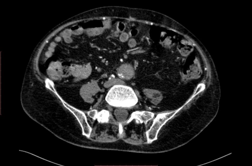 Abdominal aortic interposition tube graft and aneurysm thrombosis (Radiopaedia 71438-81857 Axial C+ arterial phase 132).jpg
