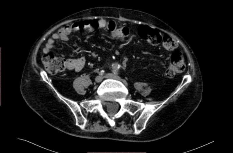 File:Abdominal aortic interposition tube graft and aneurysm thrombosis (Radiopaedia 71438-81857 Axial C+ arterial phase 136).jpg