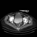 Abdominal wall recurrence after colorectal resection for cancer (Radiopaedia 23444-23523 Axial C+ portal venous phase 36).jpg