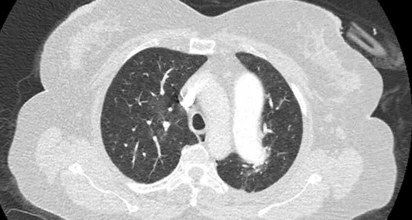 Accessory right inferior hepatic vein (Radiopaedia 65245-74259 Axial lung window 16).jpg