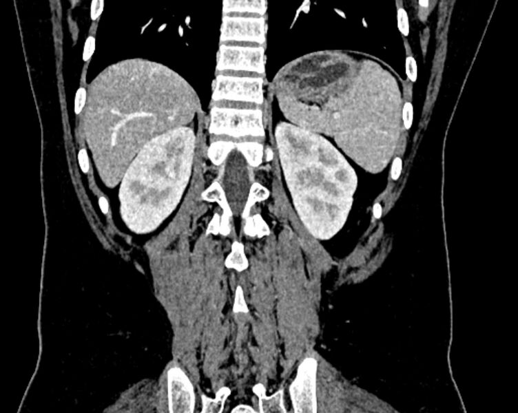 File:Accessory right inferior hepatic vein (Radiopaedia 75207-86305 Coronal C+ portal venous phase 61).jpg