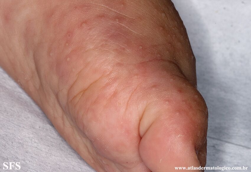 Acropustulosis Infantile (Dermatology Atlas 18).jpg