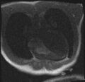 Active right ventricular cardiac sarcoidosis (Radiopaedia 55596-62100 Axial Dynamic perfusion scan MOCO 24).jpg