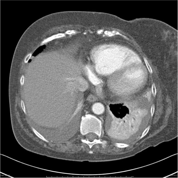 File:Acute-on-chronic pulmonary emboli (Radiopaedia 27925-28169 C+ CTPA 64).jpg