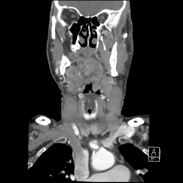 File:Acute ICA ischemic penumbra due to high-grade CCA stenosis (CT perfusion) (Radiopaedia 72038-82530 Coronal C+ arterial phase 10).jpg