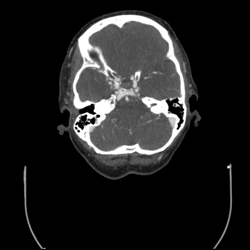 Acute M1 occlusion with ischemic penumbra (CT perfusion) (Radiopaedia 71897-82344 Axial C+ arterial phase thins 112).jpg