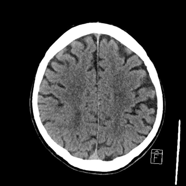 File:Acute P1 occlusion with PCA ischemia penumbra (CT perfusion) (Radiopaedia 72084-82586 Axial non-contrast 32).jpg