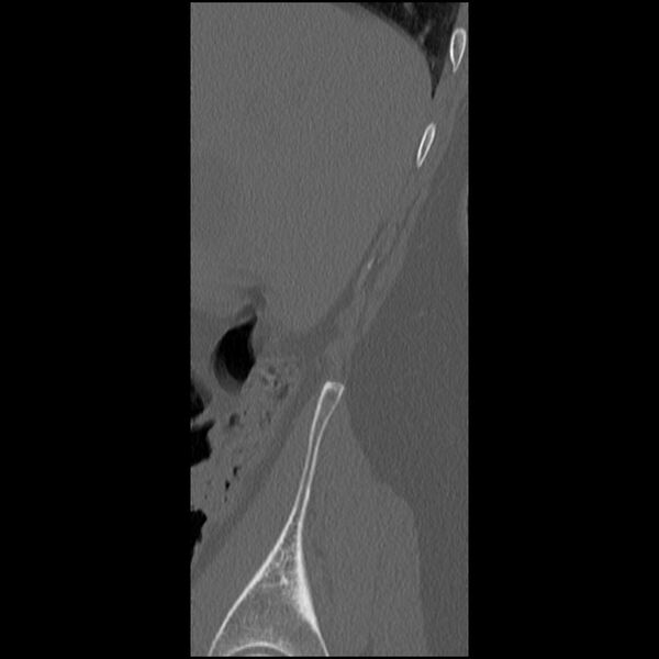 File:Acute Schmorl's node (Radiopaedia 83276-102365 Sagittal bone window 81).jpg