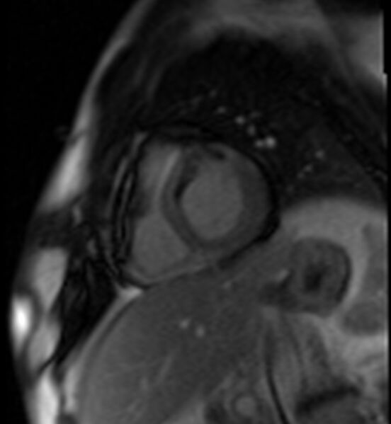 File:Acute anteroseptal myocardial infarction (Radiopaedia 68409-77945 Short axis (basal) Perfusion 41).jpg