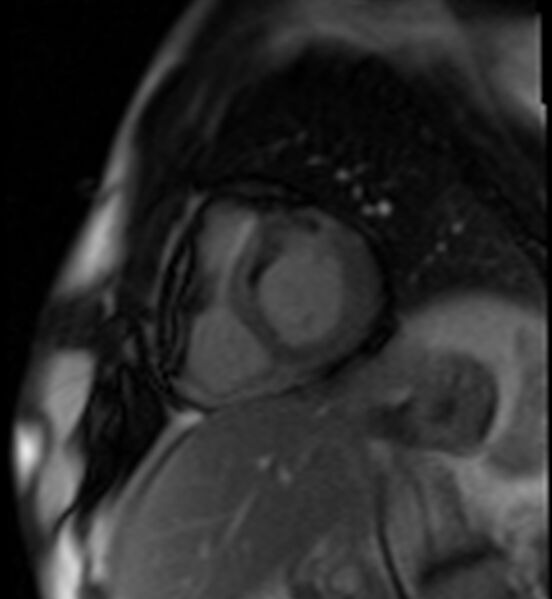 File:Acute anteroseptal myocardial infarction (Radiopaedia 68409-77945 Short axis (basal) Perfusion 42).jpg