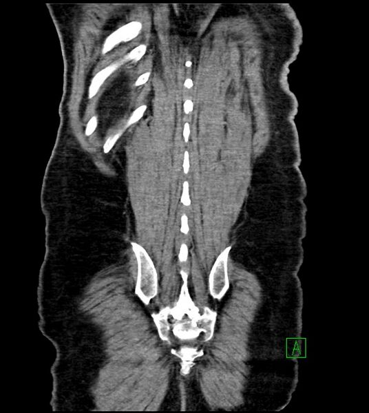 File:Acute arterial mesenteric ischemia (Radiopaedia 78238-90828 Coronal C+ portal venous phase 80).jpg