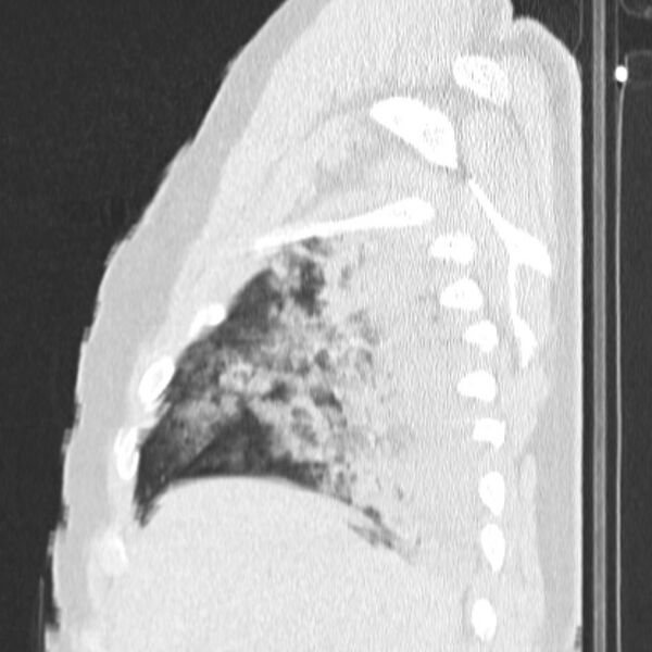 File:Acute aspiration pneumonitis (Radiopaedia 33605-34703 Sagittal lung window 19).jpg