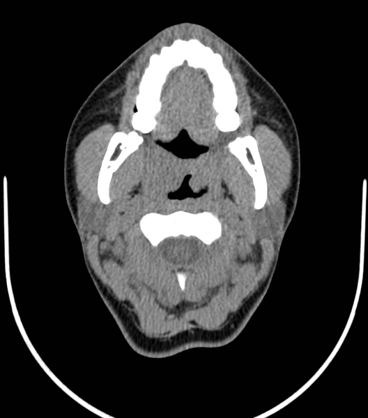 File:Acute bacterial tonsillitis (Radiopaedia 22882-22908 Axial non-contrast 15).png
