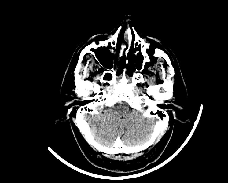 File:Acute cerebral infarct (Radiopaedia 35604-37123 Axial non-contrast 15).jpg