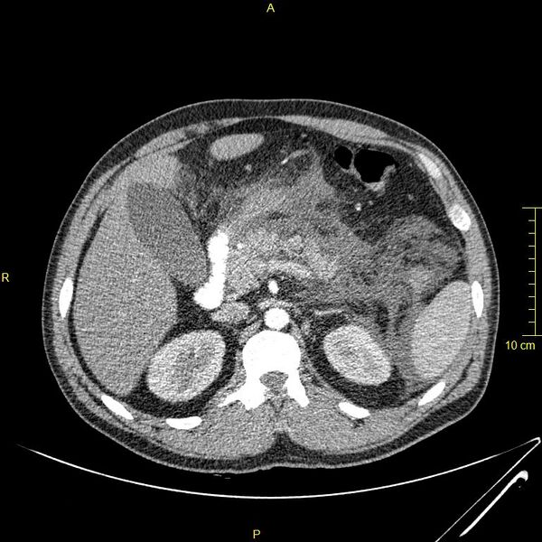 File:Acute pancreatitis (Radiopaedia 23231-23290 Axial C+ arterial phase 45).JPG