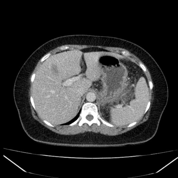 File:Acute pancreatitis - Balthazar C (Radiopaedia 26569-26714 Axial C+ portal venous phase 29).jpg