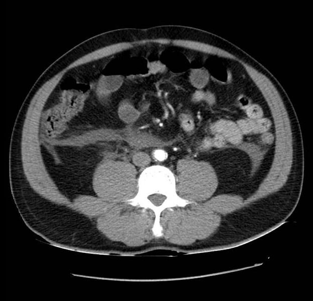 File:Acute pancreatitis - Balthazar E (Radiopaedia 23080-23110 Axial C+ arterial phase 41).jpg