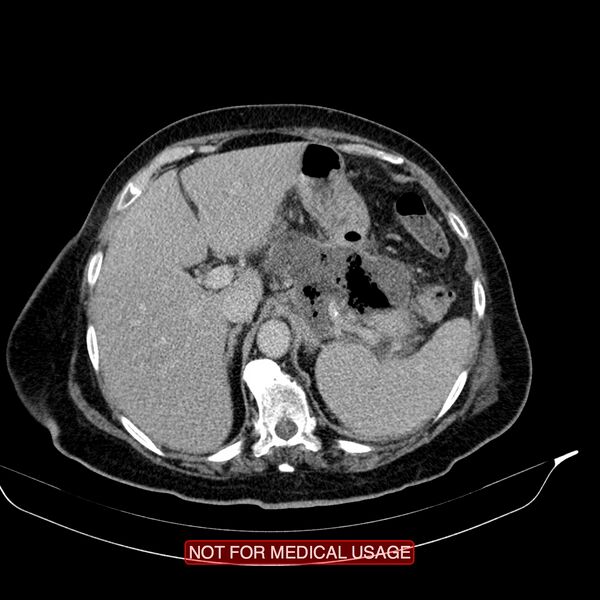 File:Acute pancreatitis with infected necrosis (Radiopaedia 26454-26585 Axial C+ delayed 6).jpg