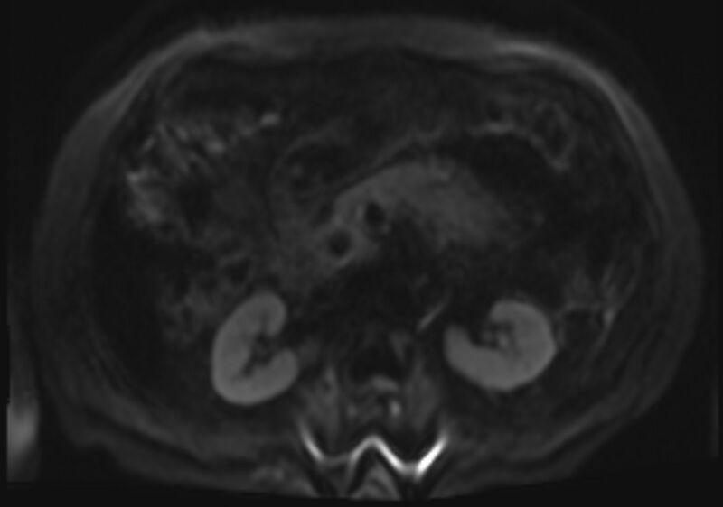 File:Acute portal vein thrombosis (Radiopaedia 73198-83925 Axial DWI 49).jpg