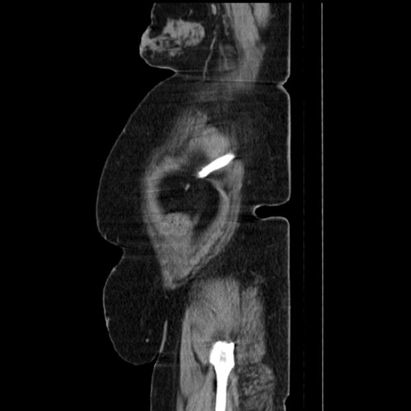 File:Acute pyelonephritis (Radiopaedia 25657-25837 Sagittal renal parenchymal phase 71).jpg