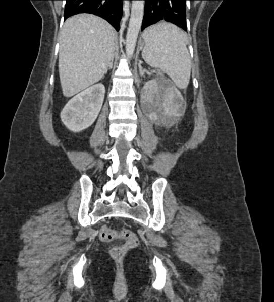 File:Acute pyelonephritis with renal vein thrombosis (Radiopaedia 58020-65053 Coronal renal parenchymal phase 83).jpg