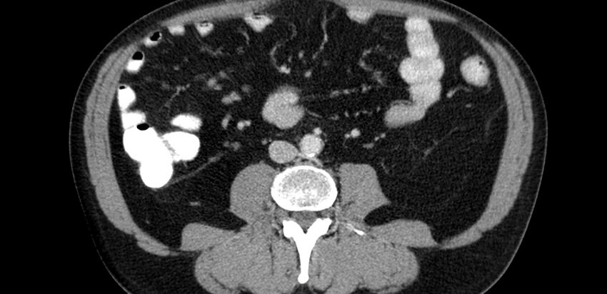 Acute sigmoid colon diverticulitis (Radiopaedia 55507-61976 Axial C+ portal venous phase 30).jpg