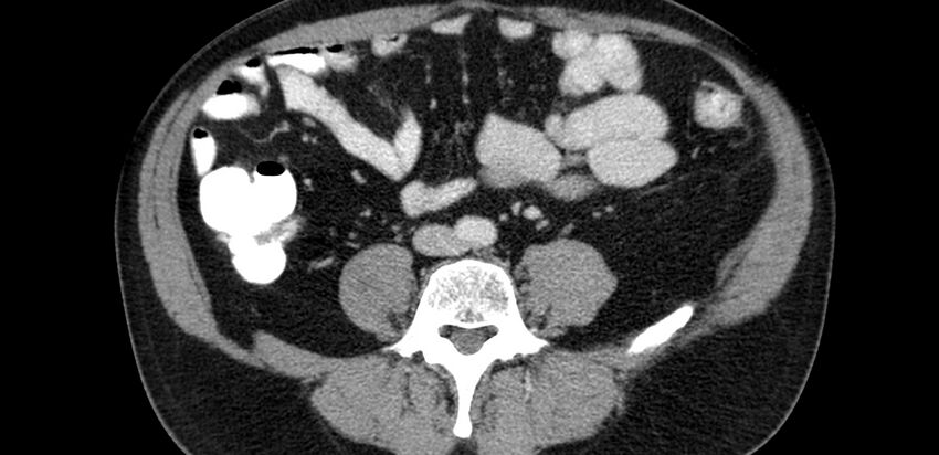 Acute sigmoid colon diverticulitis (Radiopaedia 55507-61976 Axial C+ portal venous phase 44).jpg