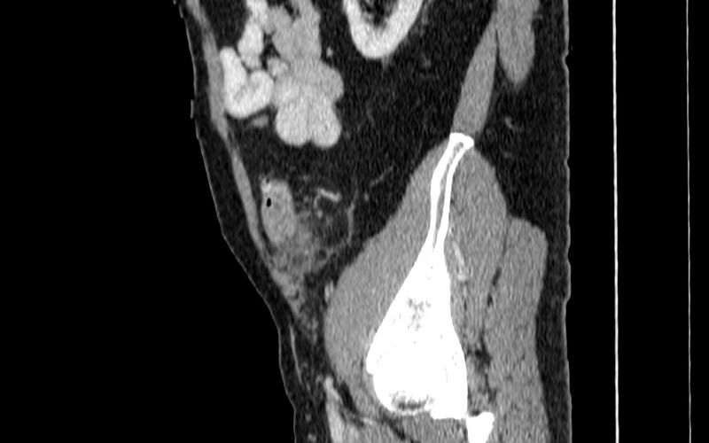File:Acute sigmoid colon diverticulitis (Radiopaedia 55507-61976 Sagittal C+ portal venous phase 94).jpg