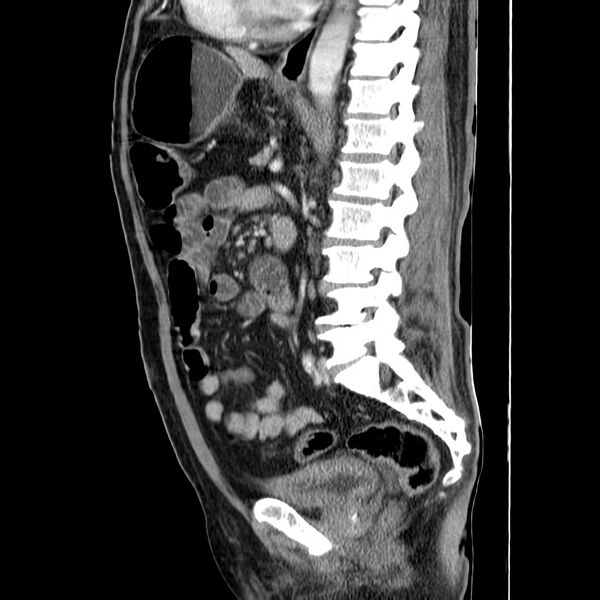 File:Adenocarcinoma of colon with entero-colic fistula (Radiopaedia 22832-22852 Sagittal C+ portal venous phase 37).jpg