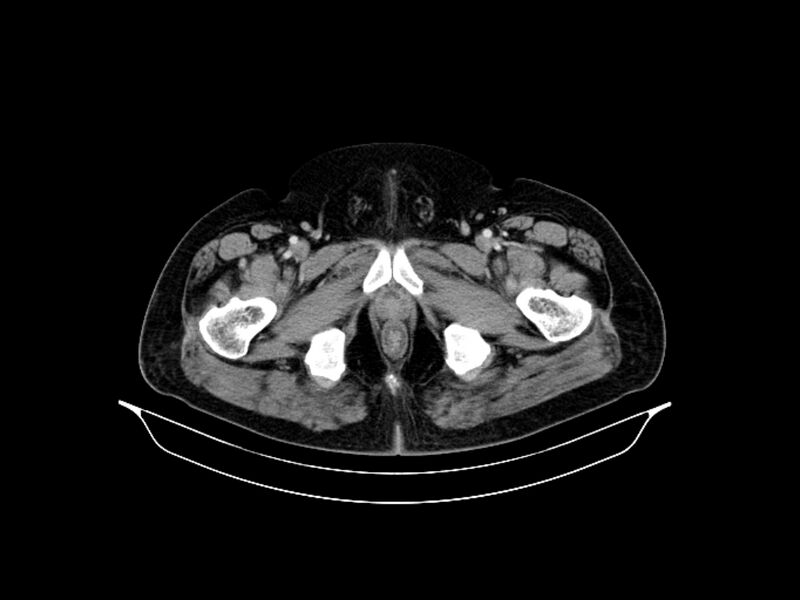 File:Adenocarcinoma of pancreas with hepatic metastasis (Radiopaedia 64332-73122 Axial C+ portal venous phase 103).jpg