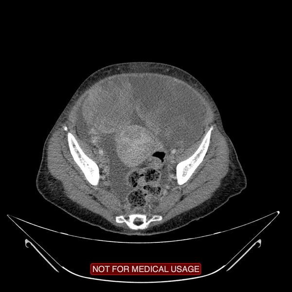 File:Adenocarcinoma of the cervix (Radiopaedia 28373-28616 Axial C+ portal venous phase 17).jpg